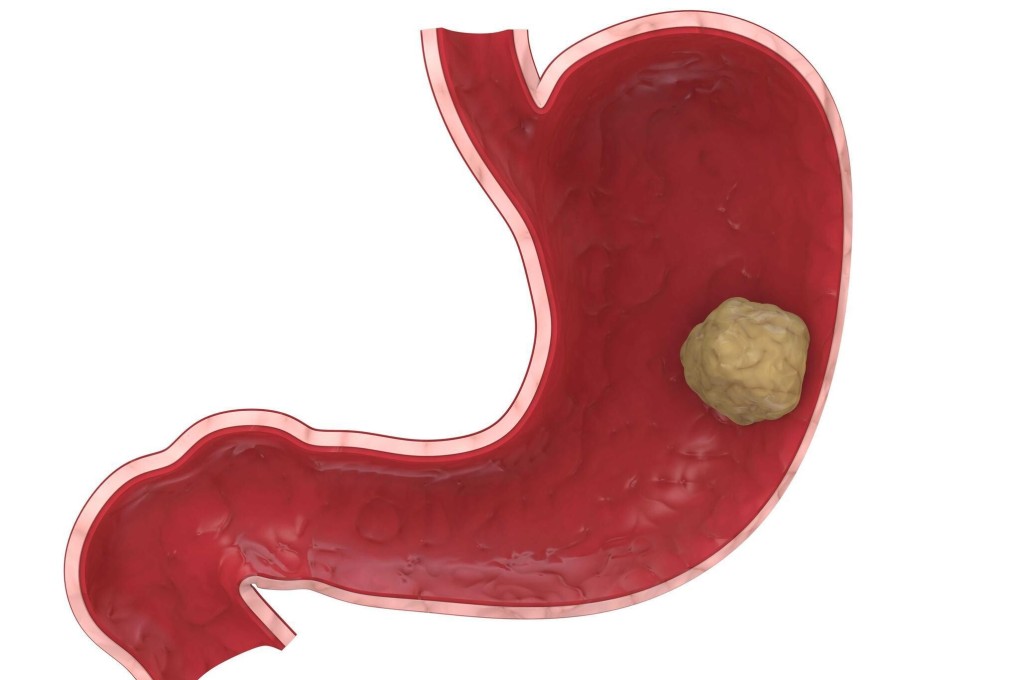 A new, affordable early detection blood test for stomach cancer developed by scientists in Singapore should improve survival rates for sufferers when it launches in Hong Kong next year.