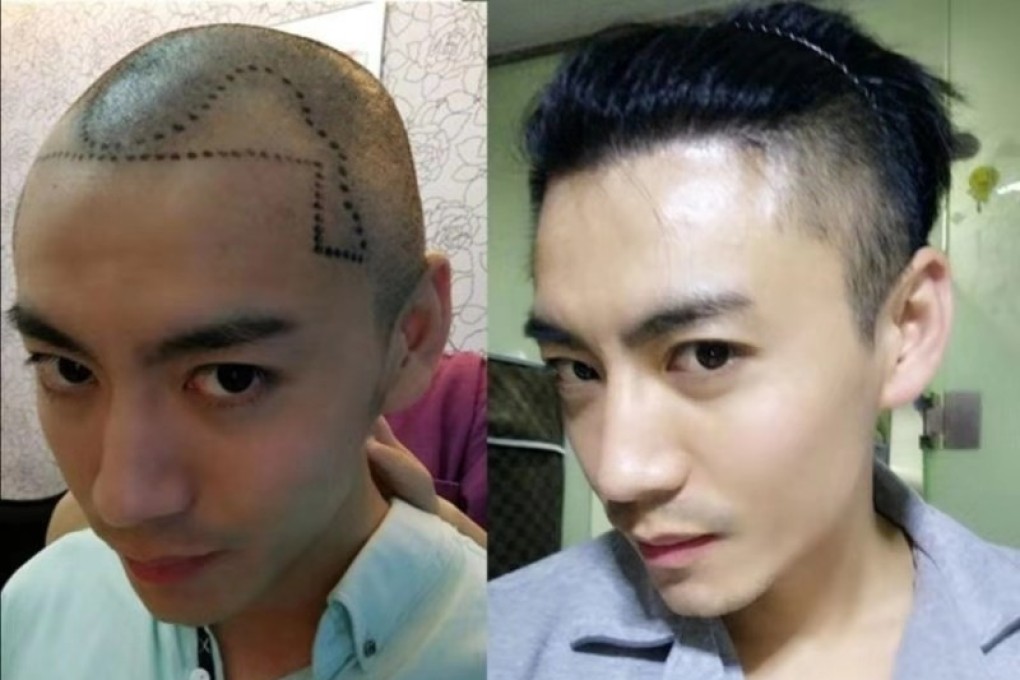 Yin Dongyi, from Beijing, the Chinese capital, before he had hair transplant surgery (left), and two years after the procedure with a full head of hair (right).