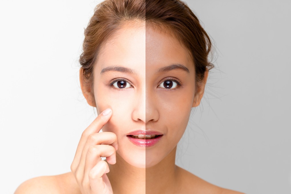 The effect of using a skin whitener. The skincare treatment can have damaging side effects.