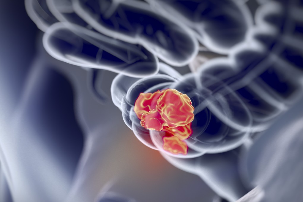 Cancer is Hong Kong’s No 1 killer, accounting for more than 30 per cent of all deaths.