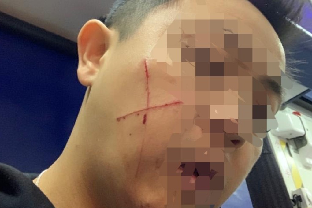An off-duty police sergeant was slashed in the face in Hong Kong as he tried to arrest a suspect on Thursday morning. Photo: Handout
