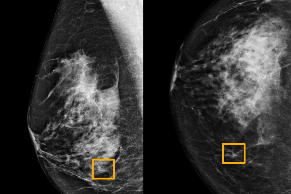 A yellow box indicates where an artificial intelligence system found cancer hiding inside breast tissue, in an undated photo released by Northwestern University in Chicago January 1, 2020. Photo: Northwestern University/Handout via Reuters