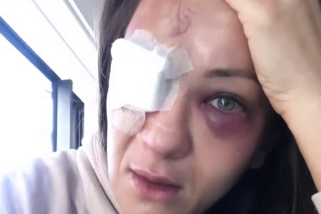 Karolina Kowalkiewicz shows her injuries. Photo: Instagram