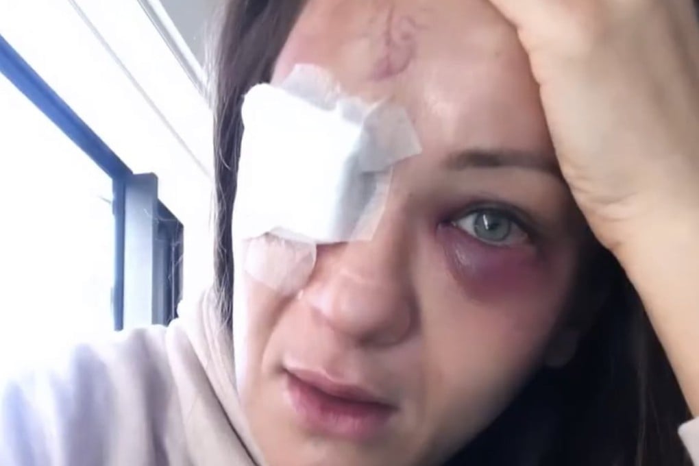 Karolina Kowalkiewicz shows her injuries. Photo: Instagram