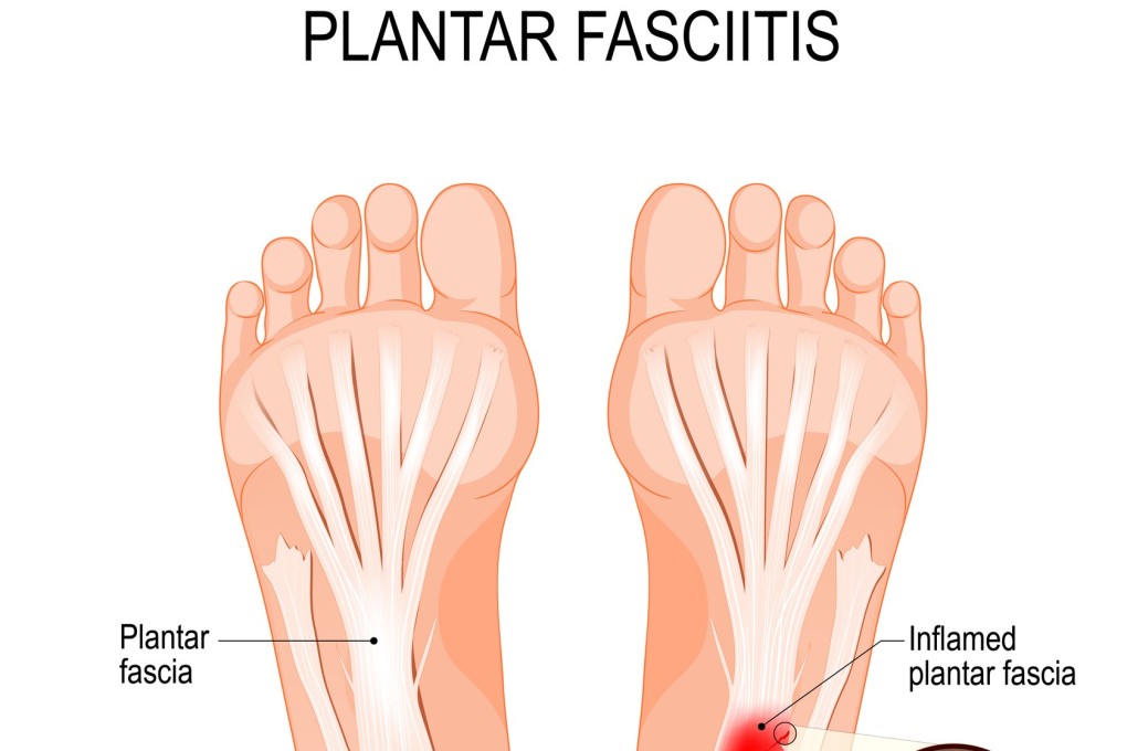 Plantar fasciitis can cripple runners, but a small adjustment in foot position or support can solve it. Photo: Getty Images/iStockphoto