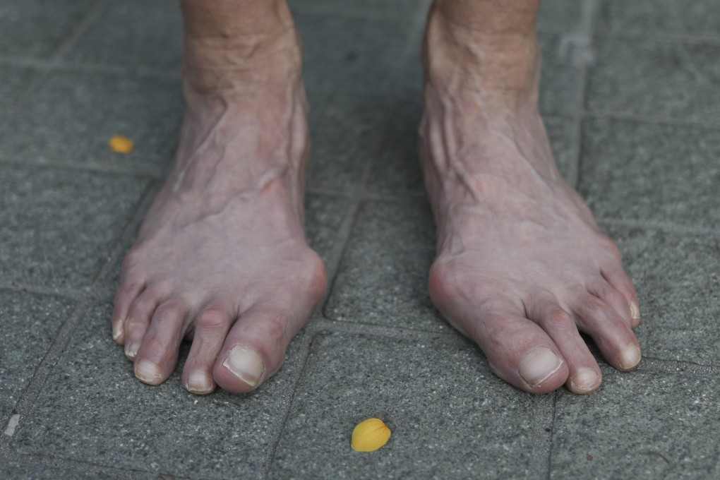 Painful toes? You might have bunions – bony bumps at the base of the big toe that are permanent until surgically removed. Photo: Tory Ho