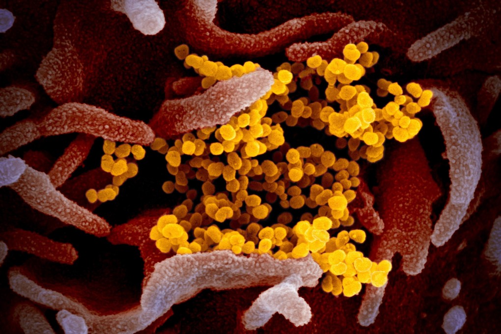 A electron microscope image of SARS-CoV-2 the virus that causes COVID-19. Photo: EPA-EFE