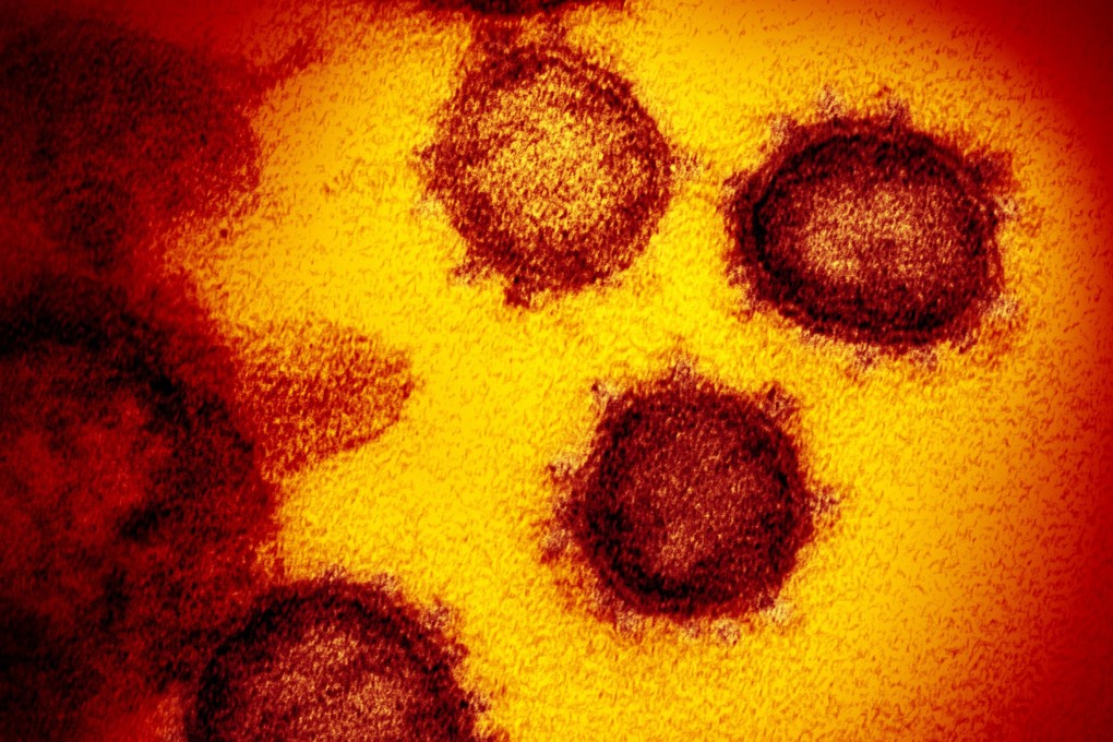 The virus that causes Covid-19, as seen under an electron microscope. Photo: AP