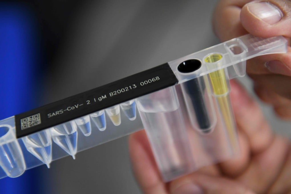 Covid-19 antibody testing detects whether a patient has been exposed to the new coronavirus. Photo: AFP