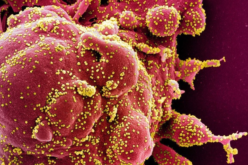A cell heavily infected with the coronavirus. Photo: AFP