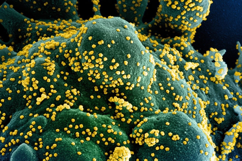 An electron micrograph shows a cell infected with coronavirus particles. A new study has found blood thinners could benefit the most severely ill patients. Photo: EPA-EFE