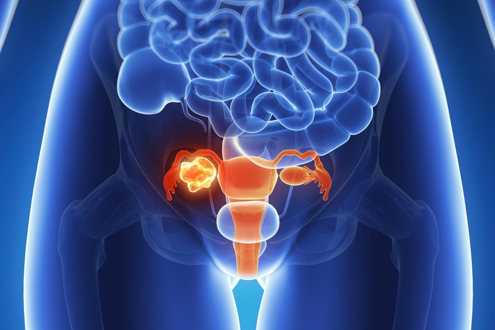 Screening is difficult for ovarian cancer and in most cases shows few symptoms until late stage. Endometriosis is considered a risk factor for two types: endometrioid carcinoma and clear-cell carcinoma. Photo: Getty Images/Science Photo Libra