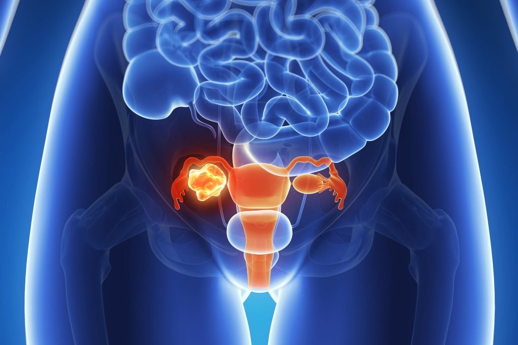 Screening is difficult for ovarian cancer and in most cases shows few symptoms until late stage. Endometriosis is considered a risk factor for two types: endometrioid carcinoma and clear-cell carcinoma. Photo: Getty Images/Science Photo Libra