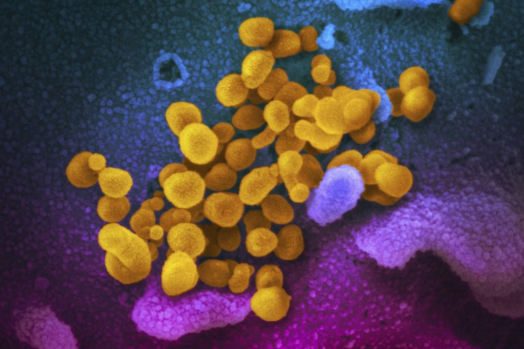 An electron microscope image of the novel coronavirus. Doctors in the US, Italy and France have seen noticed a rare but serious condition in children linked with Covid-19. Photo: AP