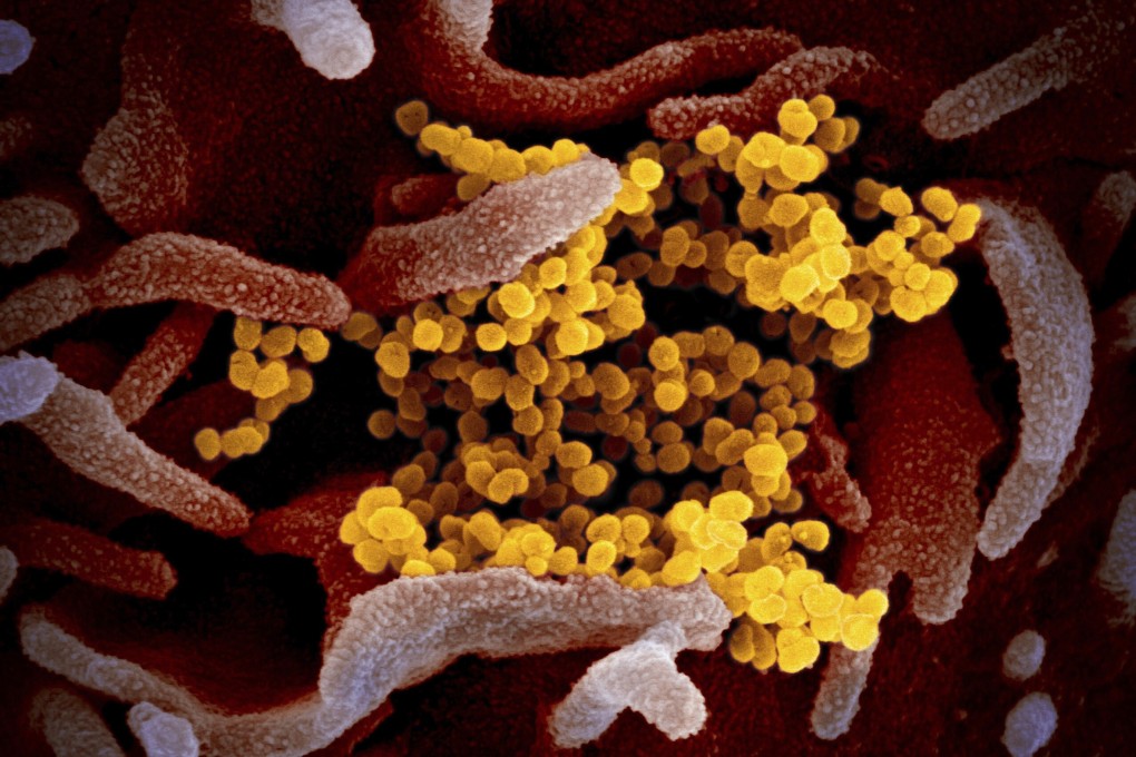 The coronavirus, shown emerging from the surface of cells, has some similarities with HIV. Photo: AP