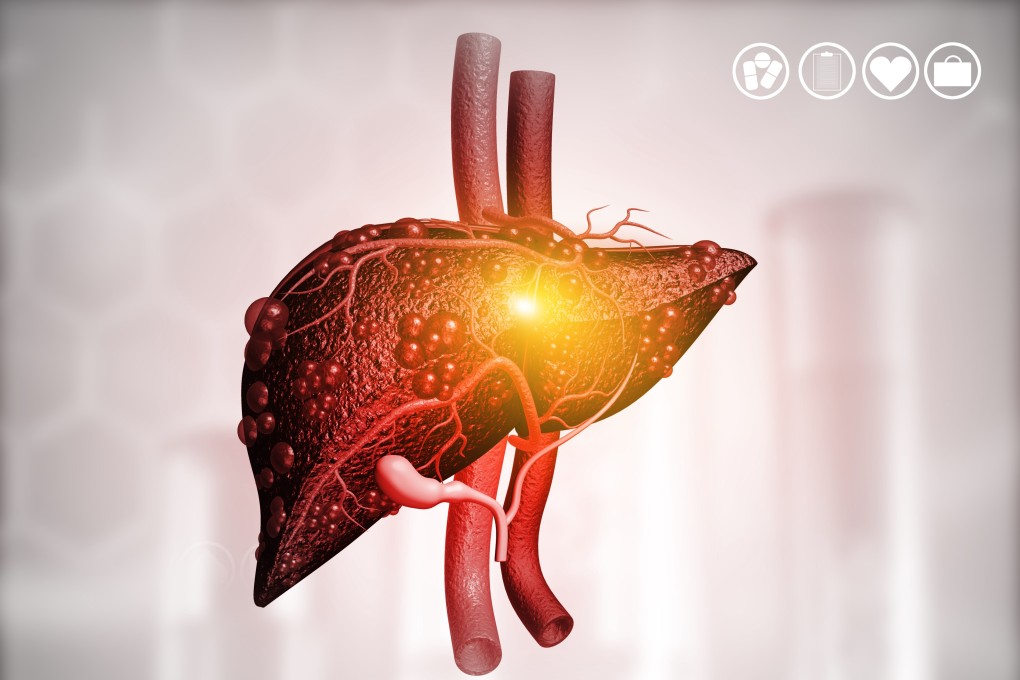 The risk of digestive tract cancers including liver cancer (above) can be reduced by taking aspirin, analysis of over 100 studies shows. Photo: Shutterstock