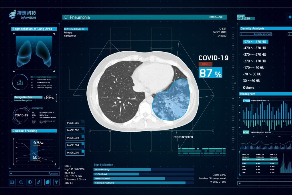 Infervision, a Chinese medical imaging AI system developer, introduced its AI-based solution for Covid-19. Photo: Handout