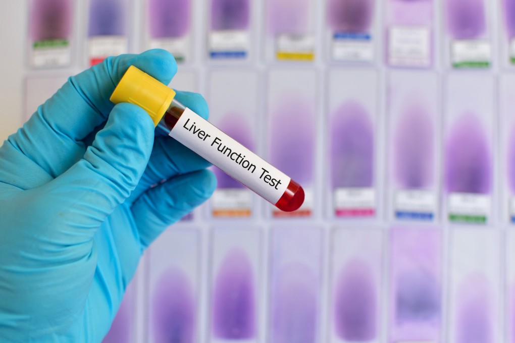 China’s liver cancer screening market could reach US$7.2 billion in 2023, according to Frost and Sullivan. Photo: Shutterstock