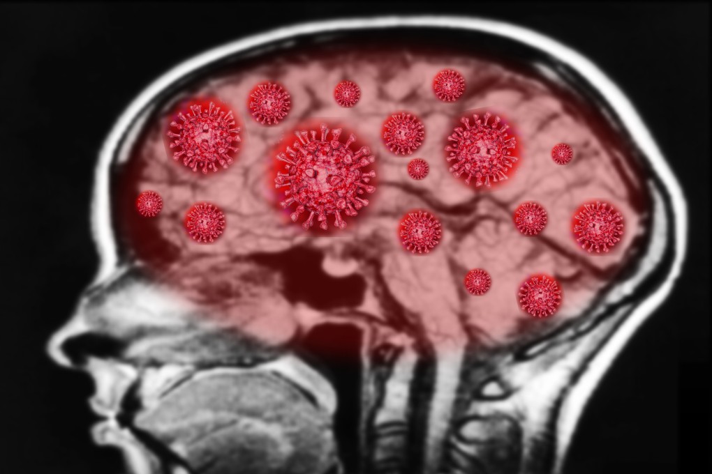 The coronavirus is known to cause neurological damage in some severe cases, but a recent study shows even mild cases can result in serious problems. Photo: Getty Images