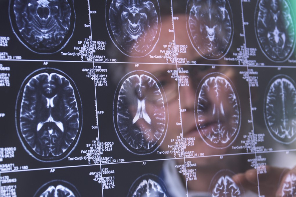 Dementia is caused when the brain is damaged by diseases, such as Alzheimer’s or stroke, and can affect people’s memory, moods and their ability to perform daily tasks. Photo: Science Photo Library via AFP