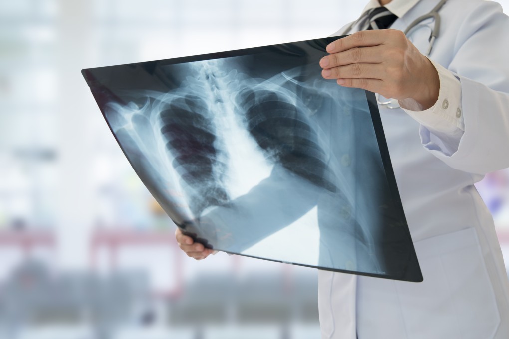 China recorded some 774,000 new lung cancer cases in 2018, almost one-fifth of all cancer cases in the nation. Photo: Shutterstock