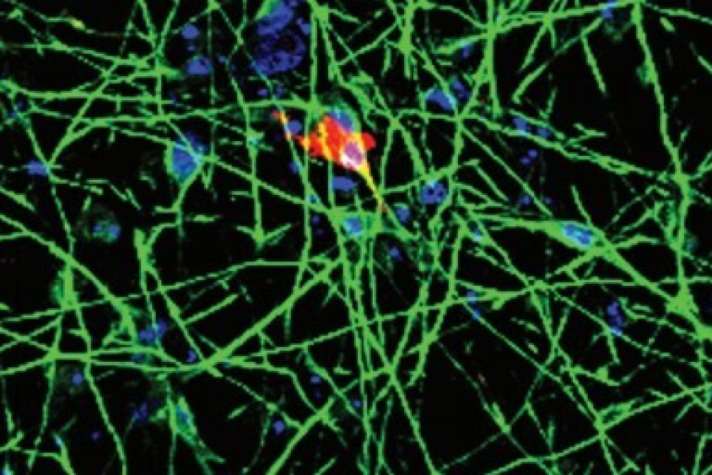 A human neuron with the rs4702 gene infected with the Sars-CoV-2. The red dots represent the virus. Photo: Kristen Brennand