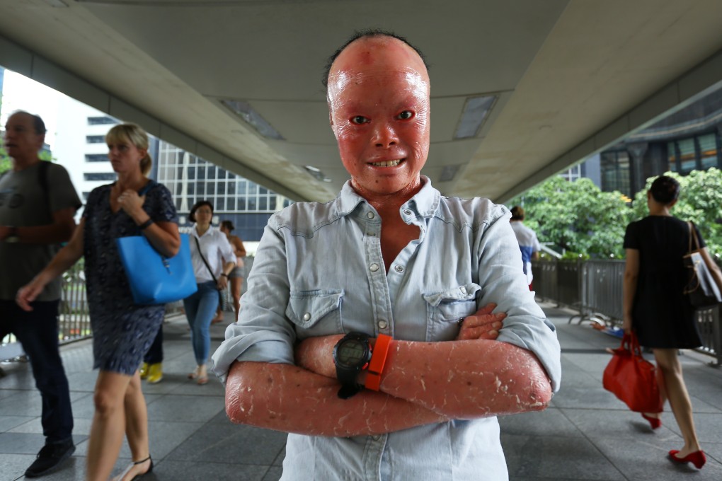 Mui Thomas, who suffers from a rare skin disorder, will share how she overcame the challenges in her life at the Accessible Wellbeing Community Event Series in Hong Kong this month, a series of health and wellness events targeting people with special needs. Photo: Edmond So