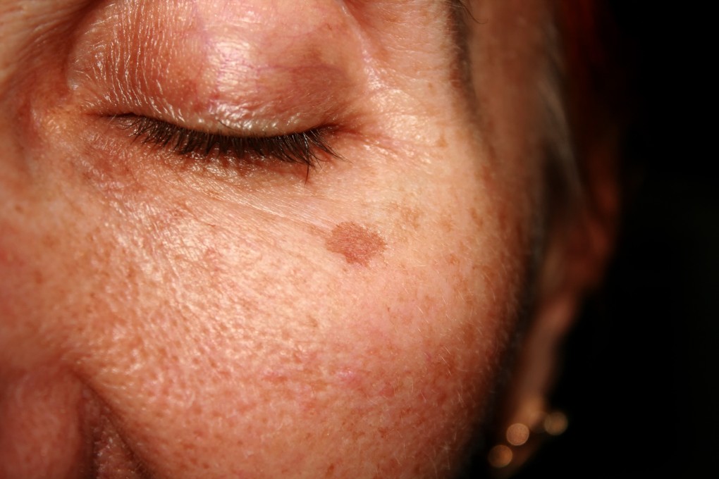 Hyperpigmentation, or dark patches on your skin, has a number of causes and can be treated with lasers, or less invasively with topical creams. Photo: Shutterstock