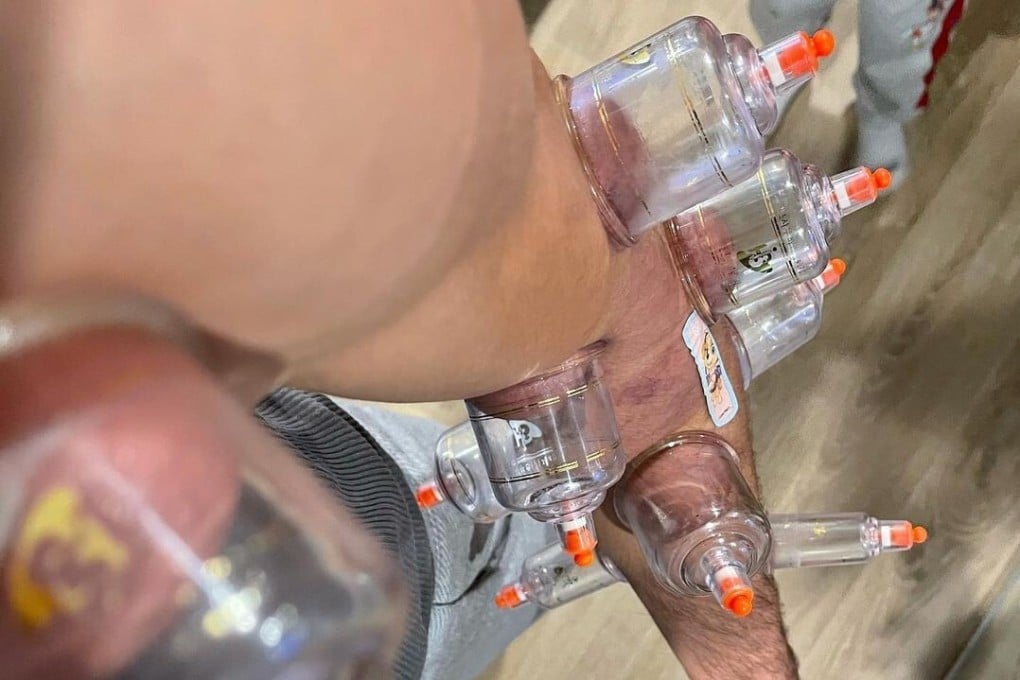 Tony Ferguson shows off his arm while receiving cupping therapy treatment after his UFC 256 defeat by Charles Oliveira. Photo: Instagram