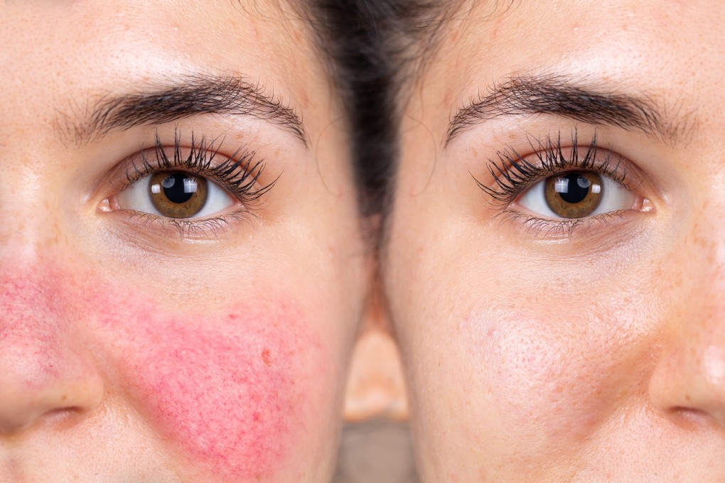 Rosacea happens to people whose skin is supersensitive, and makes it more so. Its cause is not yet well understood. Sufferers can control and mask it, though. Photo: Shutterstock