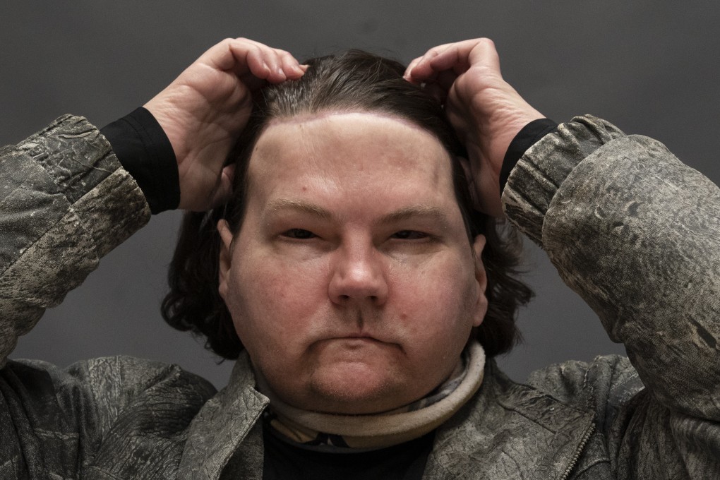 Joe DiMeo brushes back his hair while posing for a portrait at NYU Langone Health in New York in January. Photo: AP