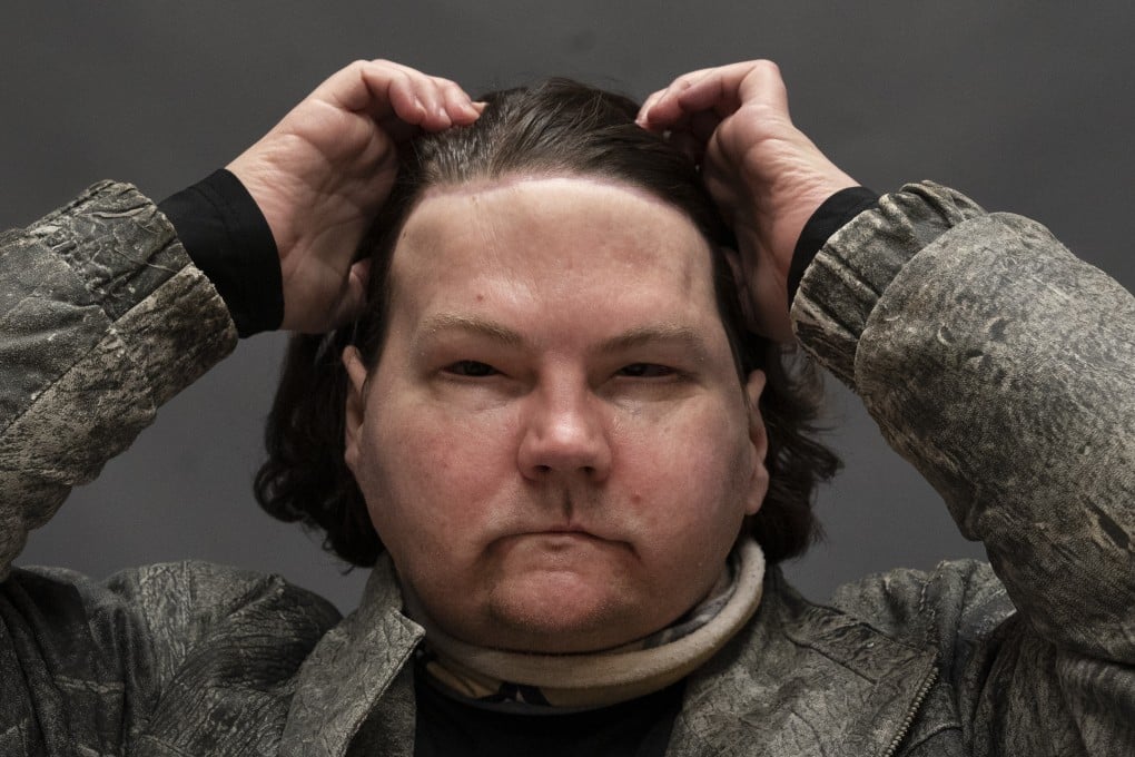 Joe DiMeo brushes back his hair while posing for a portrait at NYU Langone Health in New York in January. Photo: AP