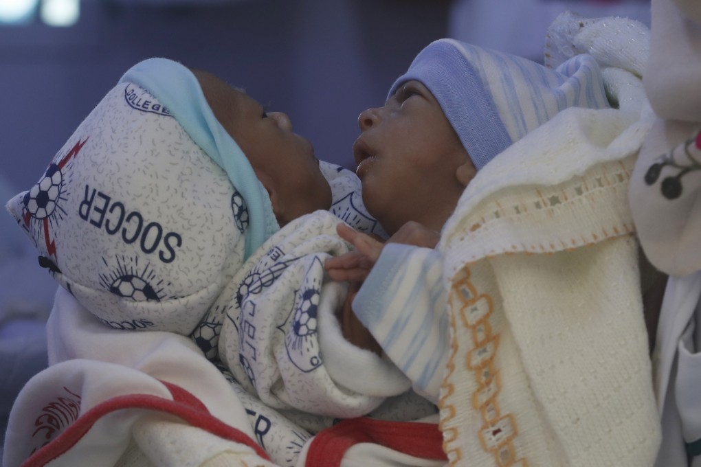 Conjoined twin brothers Muhammed, right, and Ahmed. Photo: EPA-EFE