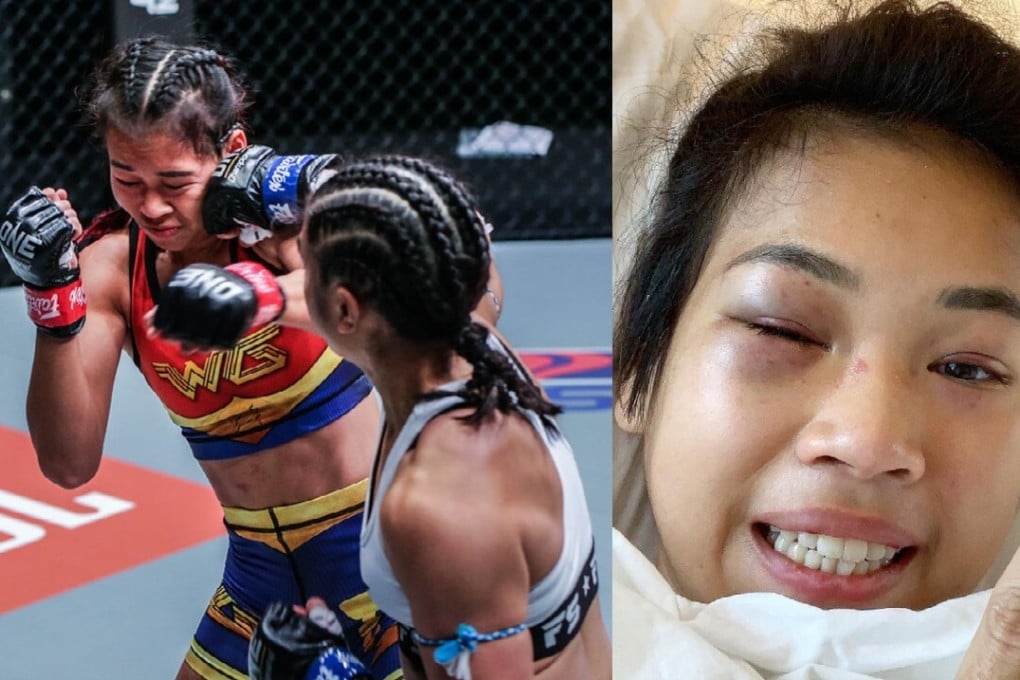 Jackie Buntan punches Wondergirl Fairtex (left), who reveals her injuries on Instagram (right). Photo: ONE Championship/@natwondergirl