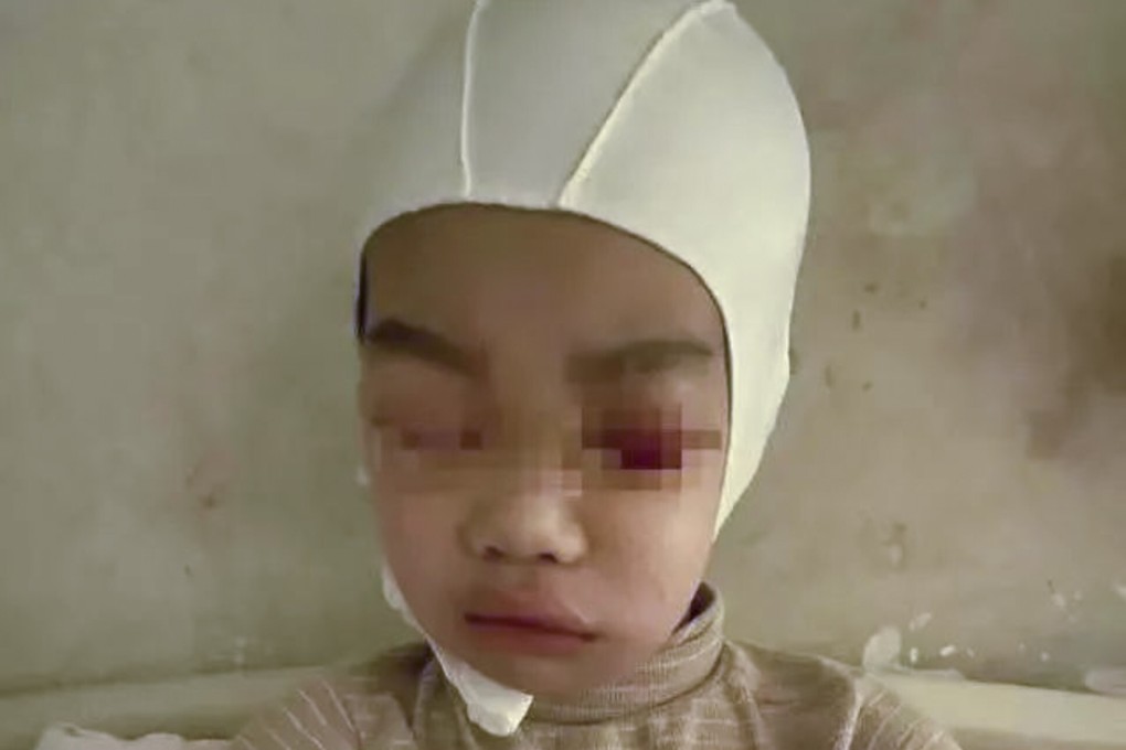 It took seven operations to remove the blood that had accumulated in the child’s brain after the incident. Photo: Handout