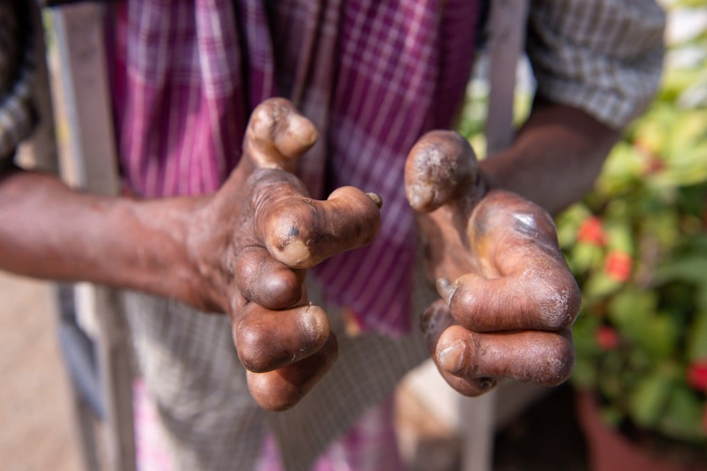 India in 2005 declared leprosy was no longer a public health problem, yet it still accounts for most of the world’s cases. Photo: Handout