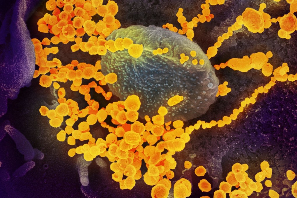 An image from a scanning electron microscope shows the coronavirus as golden round dots emerging from the surface of cells cultured in a lab. Photo: AFP