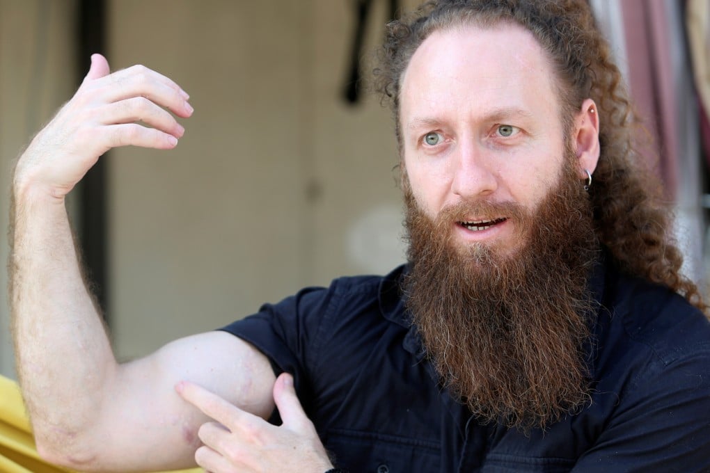 Shady Rizk, a survivor wounded during last year's Beirut port blast, shows his scars. Photo: Reuters