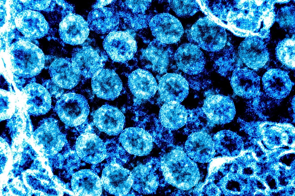 A transmission electron colour-enhanced micrograph of coronavirus particles. File photo: AFP