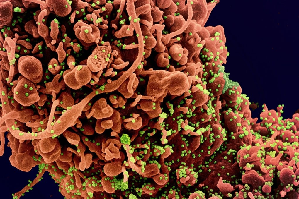 An image from a scanning electron microscope shows coronavirus particles in green on an infected human cell. Photo: EPA-EFE