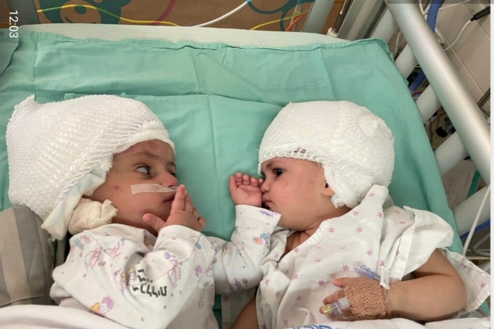 Israeli twins look at one another after having undergone separation surgery in Beersheba, Israel on Monday. Photo: Soroka Medical Centre via Reuters