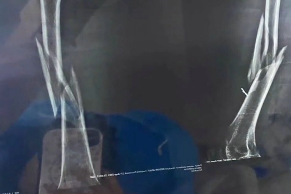 An X-ray shared by Wang shows her femur fracture after a yoga accident. Photo: new.qq.com