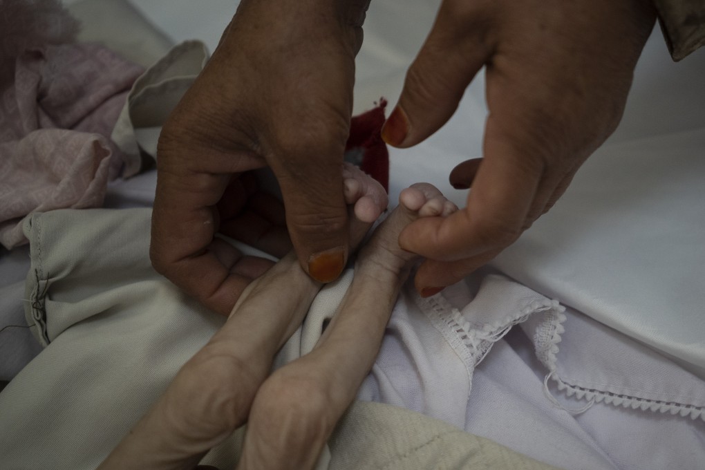 The stepmother of a malnourished child holds his legs in the Indira Gandhi hospital in Kabul, Afghanistan. Photo: AP