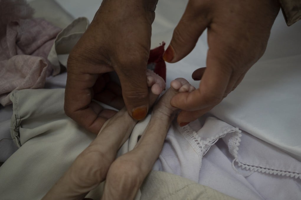 The stepmother of a malnourished child holds his legs in the Indira Gandhi hospital in Kabul, Afghanistan. Photo: AP