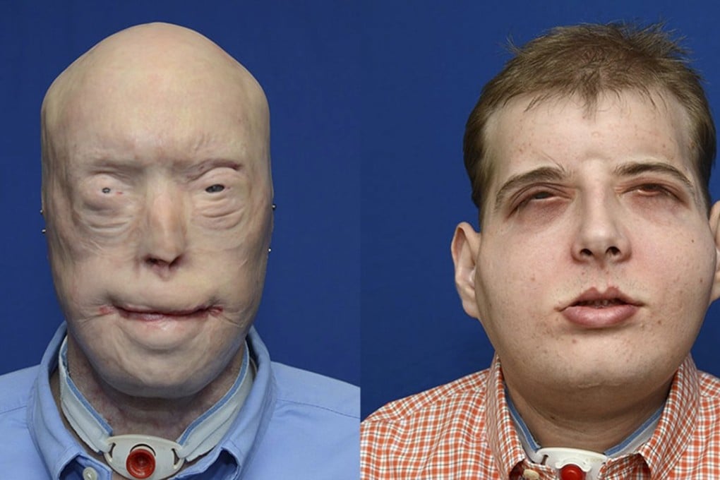 Volunteer firefighter Patrick Hardison, 41, of Senatobia, Mississippi is shown in this composite photo showing him before and after face transplant surgery. Photo: Reuters