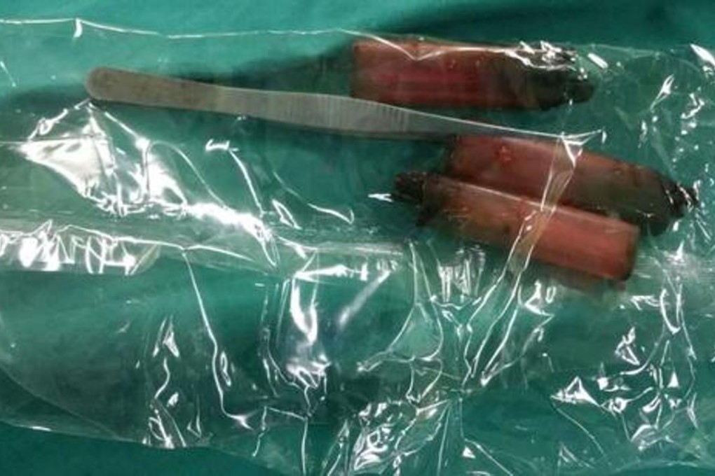 The tweezers and lighters removed from the man’s stomach. Photo: Sina.com