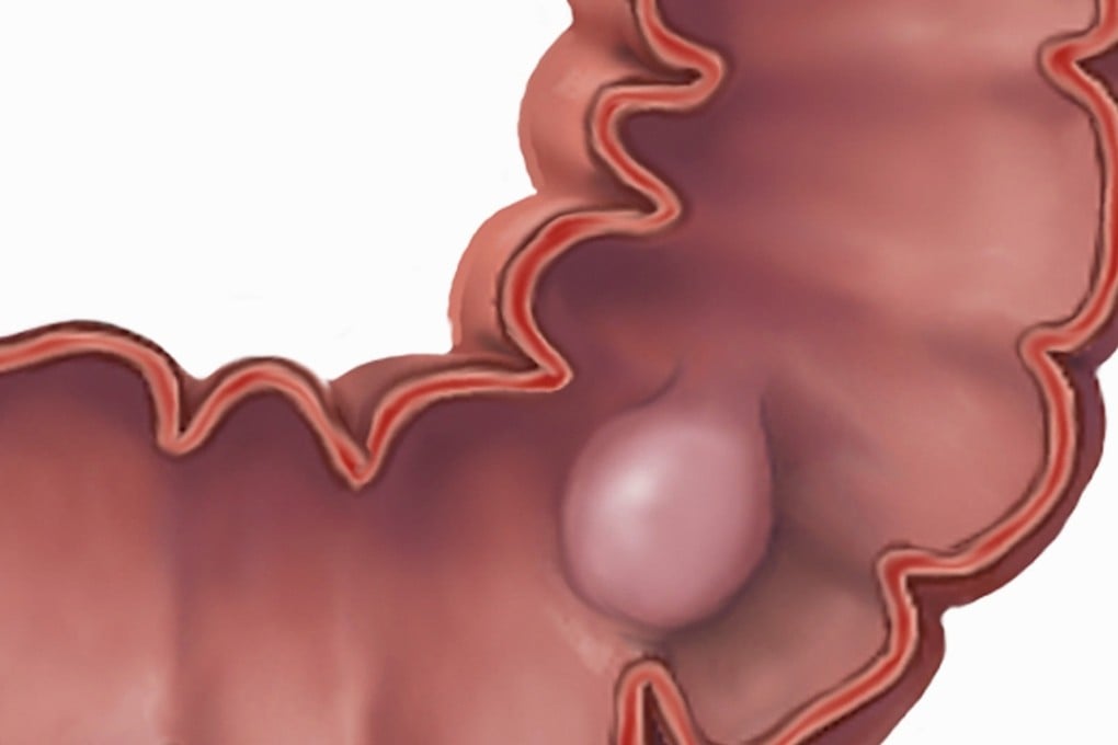 Medical illustration of a colon polyp. Photo: Corbis