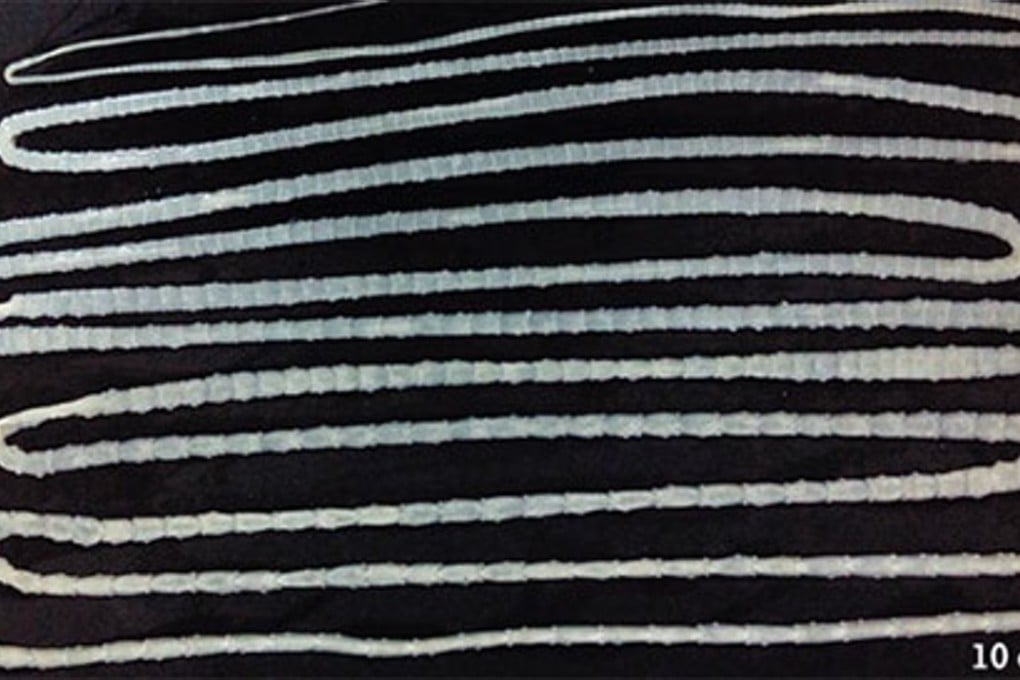 The tapeworm grew to 6.2metres. Photo: The New England Journal of Medicine