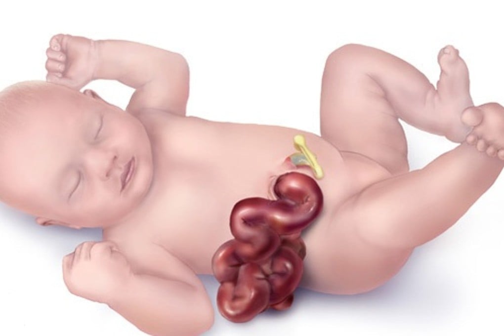 An illustration by the US Centres for Disease Control, depicting an infant suffering gastroschisis. Graphic: US CDC
