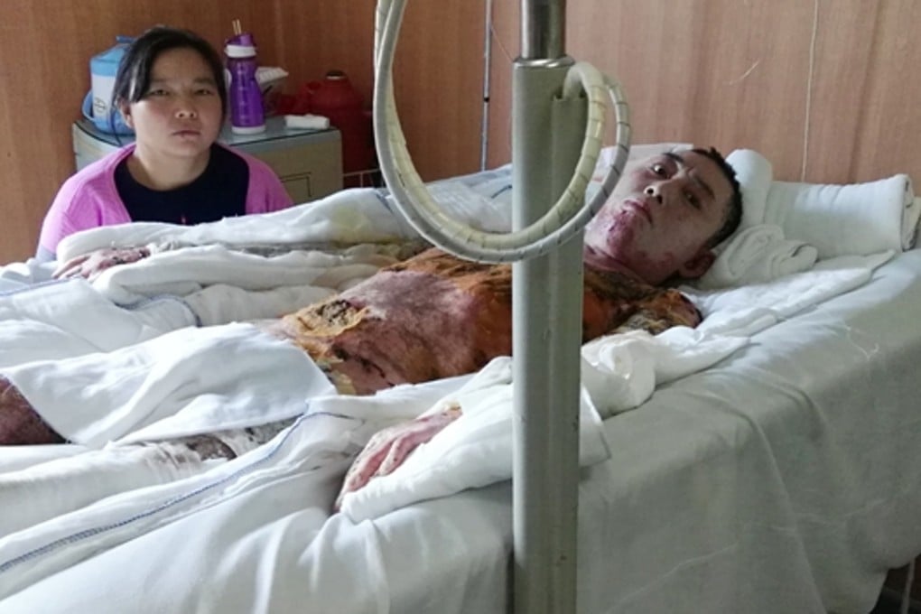 Yuan Longhua, a factory worker from Yunnan province, survived after suffering 99 per cent burns to his body after falling into a vat of boiling slurry while at work. Photo: Xinhua